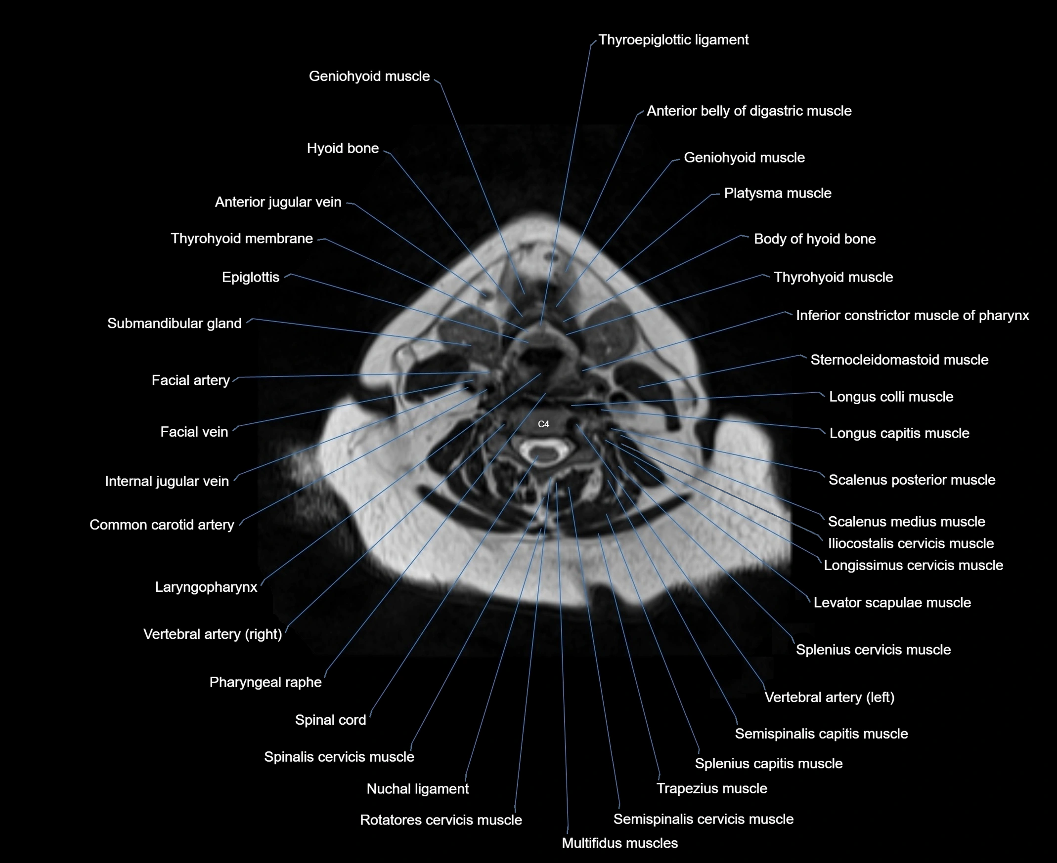 MRI Neck 3D labelled cross section anatomy axial 3t image-00001-00052.webp